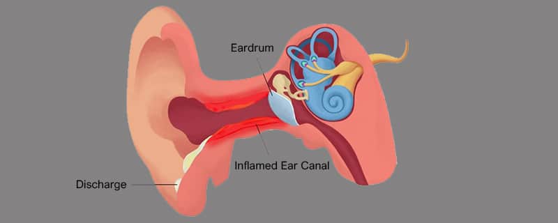 Outer Ear Infection