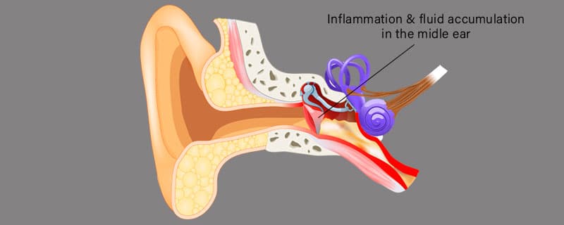Middle Ear Infection (Otitis Media)