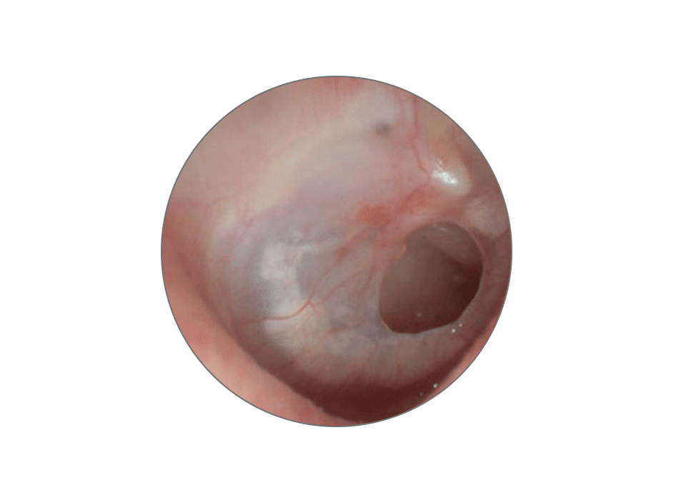 Perforated Ear Drum