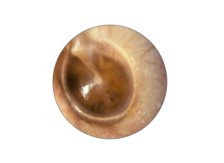 Clinical Examination Of The Ear 0154